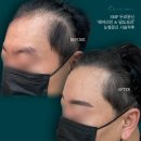 사라헤어라인