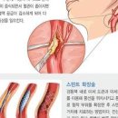 동맥경화 혈관 막힘 원인 증상 치료 총정리 이미지