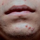 오렌지성형외과의원 | 꾸준한 관리로 달라진 내 피부, 피부미백 성공 후기 공유해요