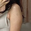웰컴바 강남성모병원점 | 강남 다이어트병원 여름 대비하려고 받은 팔뚝 지방분해주사 가격, 효과 후기