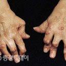 손가락 마디 통증 이유가 뭘까? 손가락 관절염 과 염증 . 이미지
