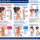 목을 앞으로 내밀고 다시 당기는 움직임 경추 전인·후인과 경추성 두통의 관계 이미지