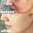 힐링약국 | 약국 기미잡티 크림 한달 사용후기 + 저자극 색소침착 관리법