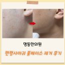 용한의원 | 얼굴편평사마귀성지 명동한의원에서 풀페이스 제거하고온 후기