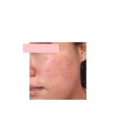 [산모] 임산부 좁쌀여드름 #01; 호르몬 변화에 따른 피부트러블, 여드름 압출로 관리하기