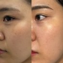 대구 중구 피부과 반월당 잡티제거 하이린 클라리티 레이저 후기