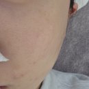 영희피부관리 | 대전 피부관리 에스테틱 아비에피부에서 PDRN 리베룩 1회 솔직 후기