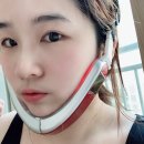 V 라인 턱, SM-V1 후기