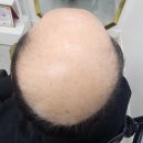 대구남자가발 김호증모가발 대구 체인 헤어슈에서 아버지의 젊음을 선물해 드렸어요