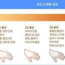 동상 (손, 발, 발가락) 이미지