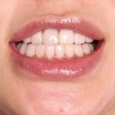 퓨어덴 치과기공소 | 올리브영 추천템 퓨어다이아 셀프 치아미백제 사용 후기