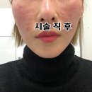 더메이피부과의원 | 의정부 비브톤의원 (전 메이퓨어 ) 쥬비덤 신제품 스킨 바이브 후기