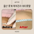 뷰티호텔 | 울산 호계 뷰티호텔 복부관리 후기 한 번에 5센티 감소