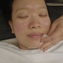 피부맑음 | [의정부호원동피부관리] 좁쌀여드름 진정 성공✨ 회룡역피부관리 맑음뷰티 후기