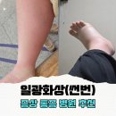 군자건항외과의원 | 마나가하에서 일광화상(썬번)으로 다리부음 통증 심해서 병원다녀옴