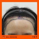 523헤어 | 잔머리 보강 중심의 헤어라인교정 후기 - 40대 여자