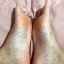 메디원스 | 라미실원스 효과 발바닥 무좀 치료 후기 과정