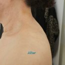 미진뷰티 | 일산 하이퍼소닉 관리 잘하는 곳, 미진뷰티 방문 후기