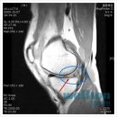 무릎 연골판과 십자인대손상-관절내시경수술 이미지
