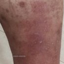 청아한의원 | 사타구니 습진 병원 어디로 가야 할까? 치료받아도 계속 재발한다면, 3가지 체크리스트