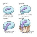 이민준한의원 | 수내동 한의원 좌골신경통증을 일으키는 원인들