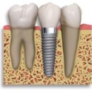 임플란트 해도 60%는 잇몸병 생겨… 예방법은? 이미지