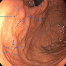 범어샘편한내과의원 | 하남내과, 과형성 용종과 기저선샘 용종의 차이점과 관리
