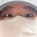 오렌지 성형외과 내돈내산 한쪽 눈 쌍수 1일차 후기