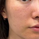 (주)지피코 1공장 | 주사피부염 치료 수원 홍조 치료 모공리액터 2회차 후기