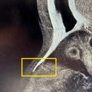 에코동 | 코뼈골절 비관혈적 정복술 후기(국소마취, 당일퇴원, 수술비 가격공유,서울 이비인후과 정보공유)