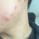 캐치비전 | [평택여드름관리] 스무살에머물다 평택비전점 다녀온 후기 (강력 추천!!)