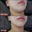 텐하이 | [뷰티] 부산 동래 피부관리 &#34;동안에스테틱&#34; 후기: 올인원 텐하이 리프팅 😎