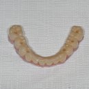 On(온)치과기공소 | [덕계동치과] 아래 틀니 흔들림 해결, All-on-X(올온엑스)로 다음날 식사까지!