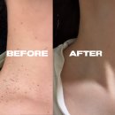 우인한의원 | 강남역 한의원 편평사마귀 제거! 편평사마귀 거우침 솔직후기 / 11일간의 과정 사진 있음!! / 편평...