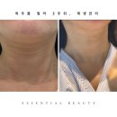 신사역 피부과 목주름필러 2주 후 LDM 재생관리 후기 가로목주름 옅어짐 효과