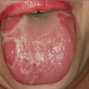 지도상설[Geographic tongue] 이미지