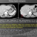 Primary Hepatic Leiomyoma 원발성 간 평활근종 이미지