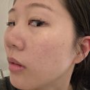 구래한의원 | 수원 모공치료 3회차! 메디컬오 한의원 모공리액터 후기!