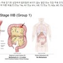 암, 자신의 병기와 상태를 알려면~ stage lllB (T3N1M0) 이 뭐지?? 이미지