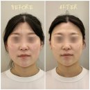 농업기술원 맞은편 | [진주에스테틱] &#39;뷰티에이블&#39; 두골비 얼굴비대칭 교정 후기