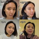 (주)노리온소프트 | 청담동 피부과 실루엣소프트 실리프팅 1주차 후기 과정 비용 총정리