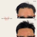 TMW 탈모왕수원 이미지