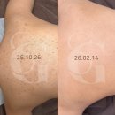 (주)범천 | 서면 등드름 필링, 10년 된 흉터 무작정 벗기지 않고 지운 12회 후기