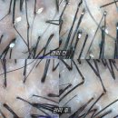 평택-평택-27 | 평택 탈모관리 유명한 곳 WT메소드평택점 두피관리 후기