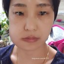 오른쪽 매복사랑니발치/사랑니발치응급실/사랑니발치후기