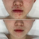 구로-현장-구로-576 | 강남여드름관리, 이것만은 알고 받으셔야 합니다.