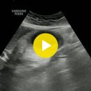 acute cholecystitis(급성 담낭염) 이미지