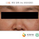 후천 양측 Ota 모반모양반 이미지