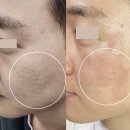 SRS | SRS 레이저 패인 여드름 흉터 치료 후기 케이스