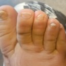 르미에르의원 | 정효경 선생님과 함께 해결. 치료 받고 2주 후 후기까지! (광화문 종로 무좀발톱 관리 통증없이 해결가능!)